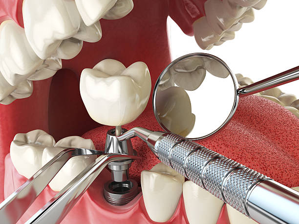 Best Lost Filling or Crown Replacement in South Pasadena, FL